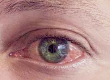El Colegio de Ópticos alerta sobre la posibilidad de contraer conjuntivitis en las aguas de las playas y piscinas durante el verano