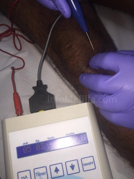 Club Voleibol Melilla: Mario Gonçalves sometido a una nueva terapia, la EPI