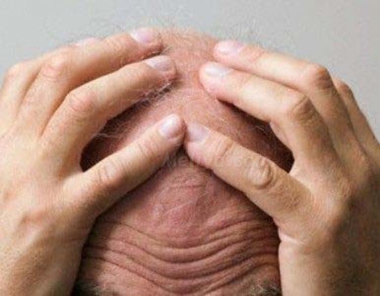 Un estudio confirma la relación entre la calvicie prematura y los problemas de próstata
